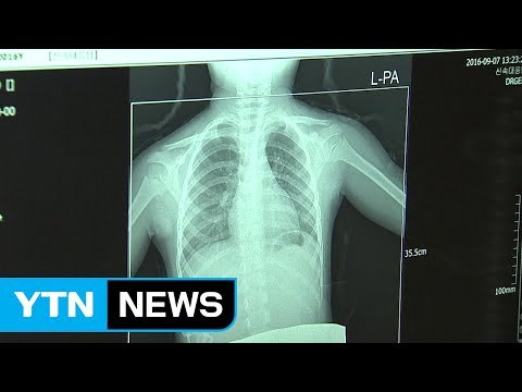 '교사 결핵' 어린이집에서 원아 등 4명 잠복 결핵 판정 / YTN (Yes! Top News)