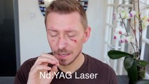 LOOK AT MY FACE - THIS IS THE YAG LASER!