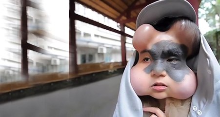 Ölümcül Doğum Lekesini Görülmemiş Bir Yöntemle Çıkardılar