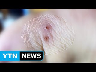 '붉은 독개미'에 물렸다면?...증상과 대처법 / YTN