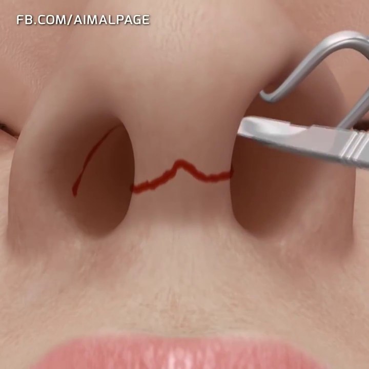 Medical Nose surgery