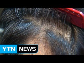 탈모, 초기에 잡아야...정확한 진단 중요 / YTN