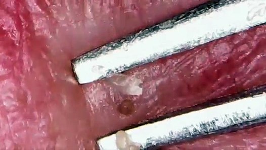 Chin Blackhead 15 顎の角栓 Video Dailymotion