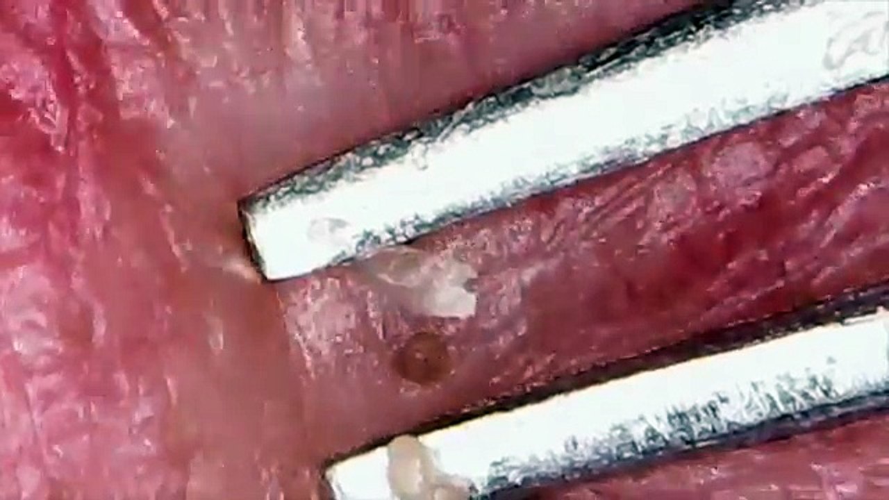 Chin Blackhead 15 顎の角栓