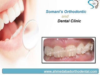 Invisible Braces in Ahmedabad at Somani’s Orthodontic