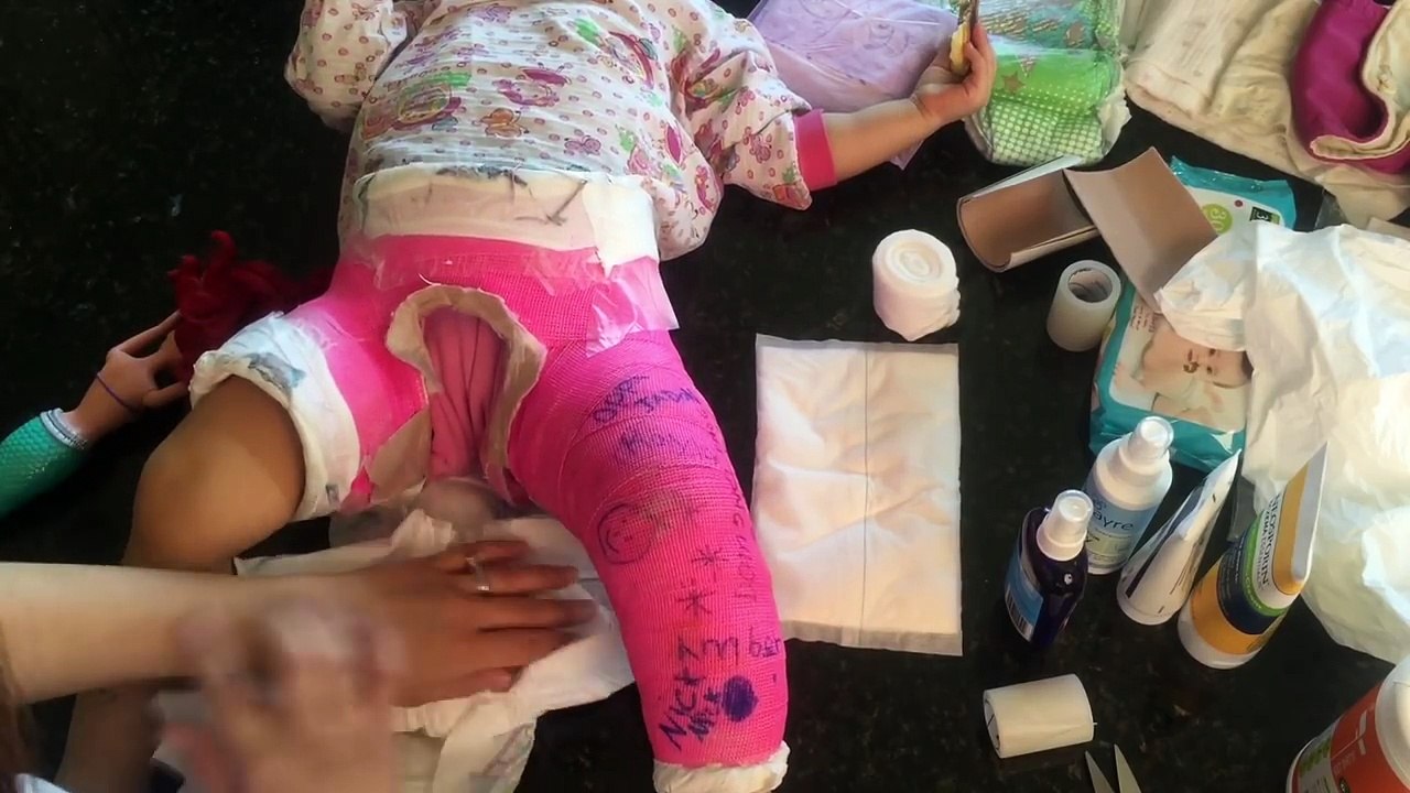 SPICA CAST CARE || removing odor & diapering