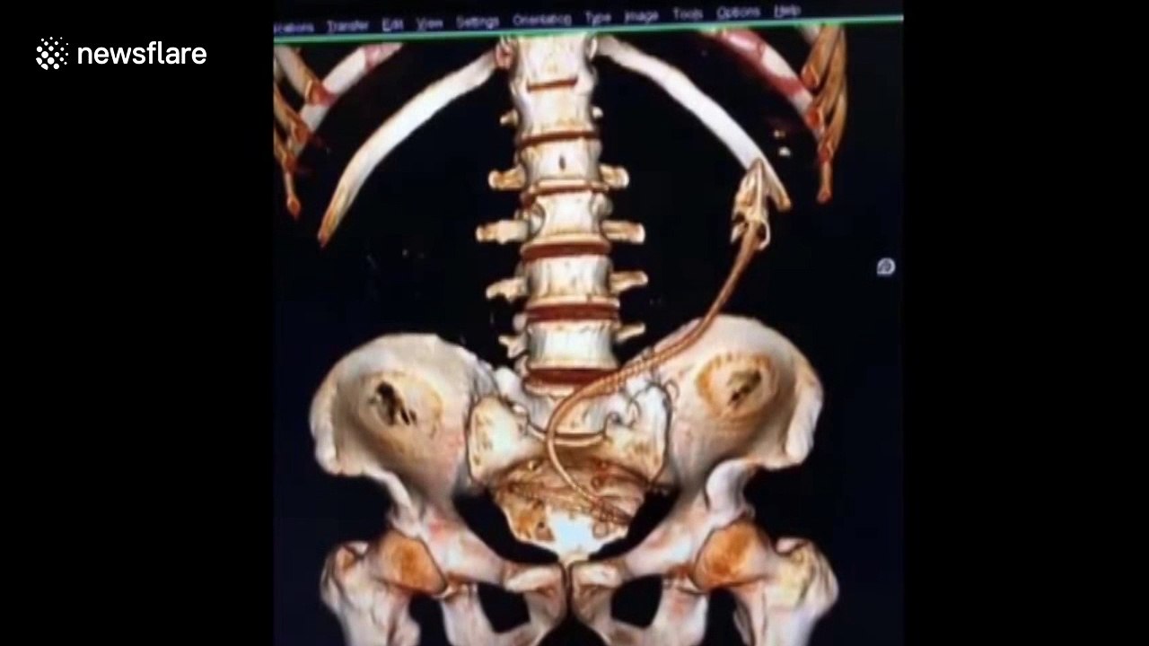 Chinese doctors remove Asian swamp eel from man's body