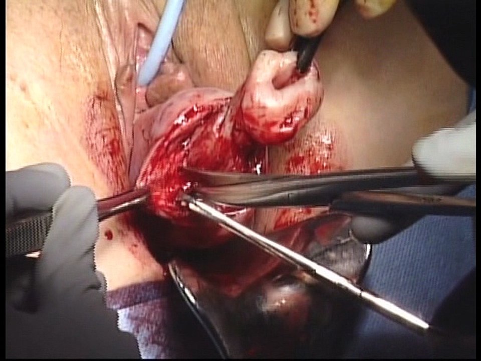 Difficult posterior entery
