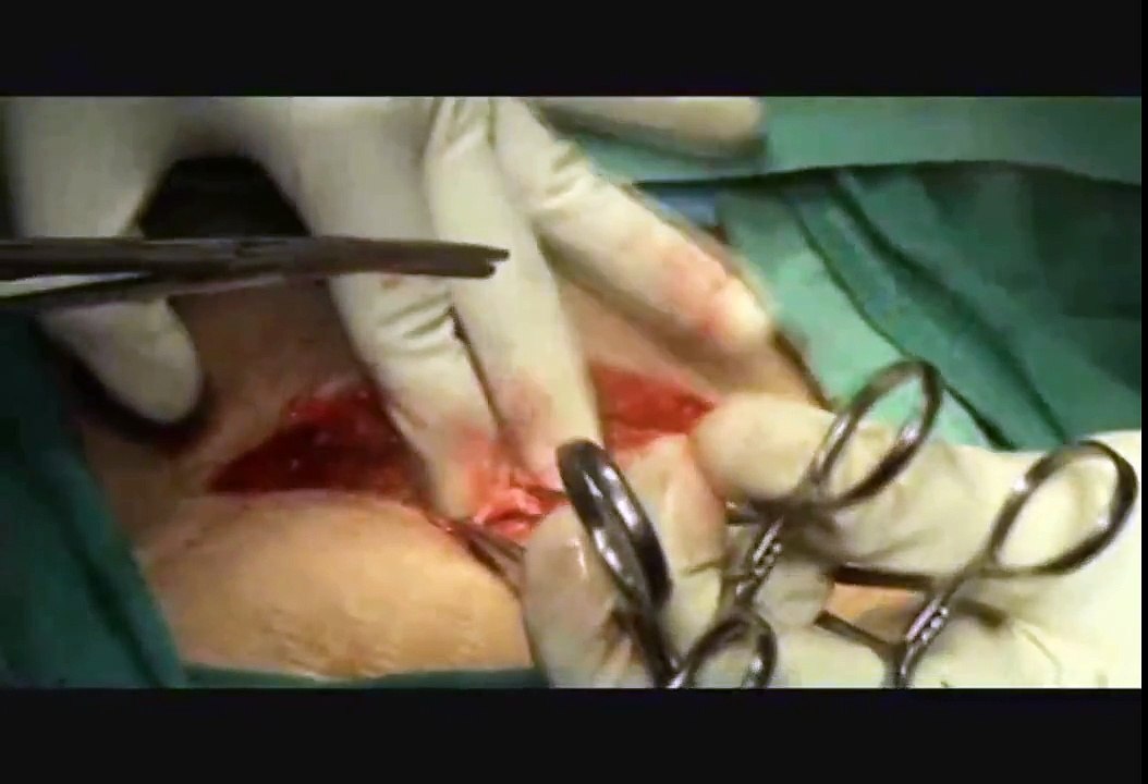Pfennesteil Incision