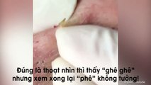 Cận cảnh pha nặn “rừng mụn đầu đen” khiến người xem sướng hết nấc vì quá đã mắt