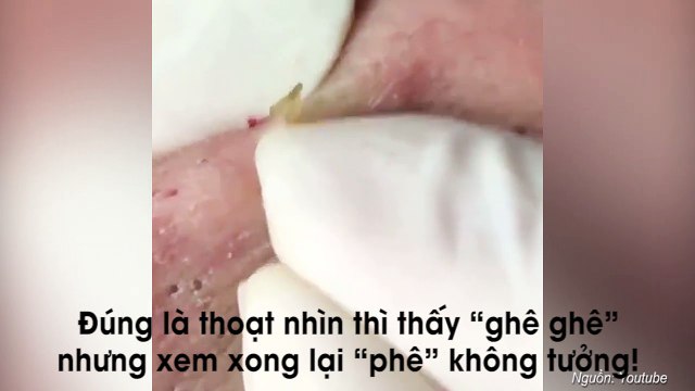 Cận cảnh pha nặn “rừng mụn đầu đen” khiến người xem sướng hết nấc vì quá đã mắt