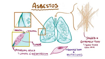 Download Video: Mesothelioma - causes, symptoms, diagnosis, treatment, pathology - YouTube