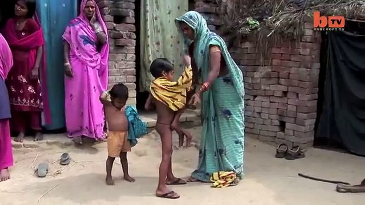The Boy with 8 Limbs in India
