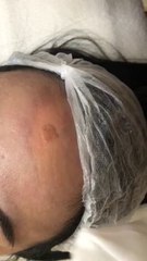 Leke/Yanık Tedavisi