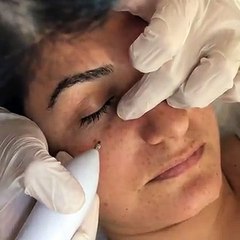 Leke Yanık Tedavisi ÇİĞDEM OLGUN