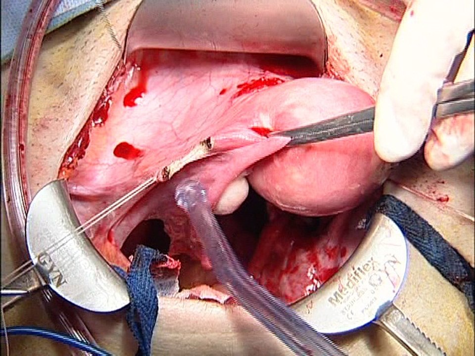 Anatomy of uterus and adenexa