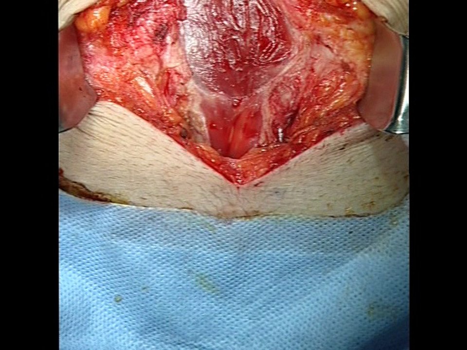Anterior abdominal wall