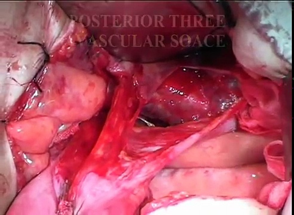 Full Detailed Pelvic Anatomy during Wertheim's Radical Hysterectomy & Pelvic Lymphadenectomy.