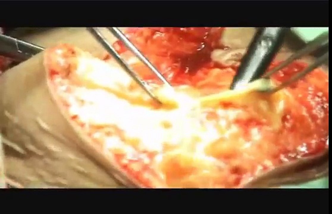 Midline Vertical Abdominal Incision Above the Umbilicus