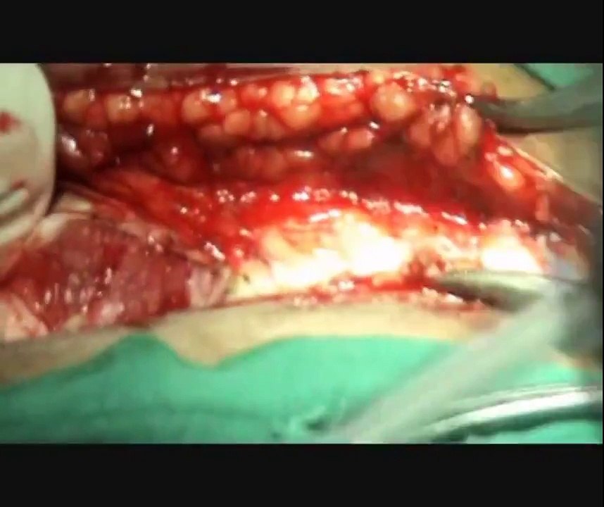 Opening The Abdomen with the Maylard Incision & ligating The Inferior Epigastric Arteries in Radical