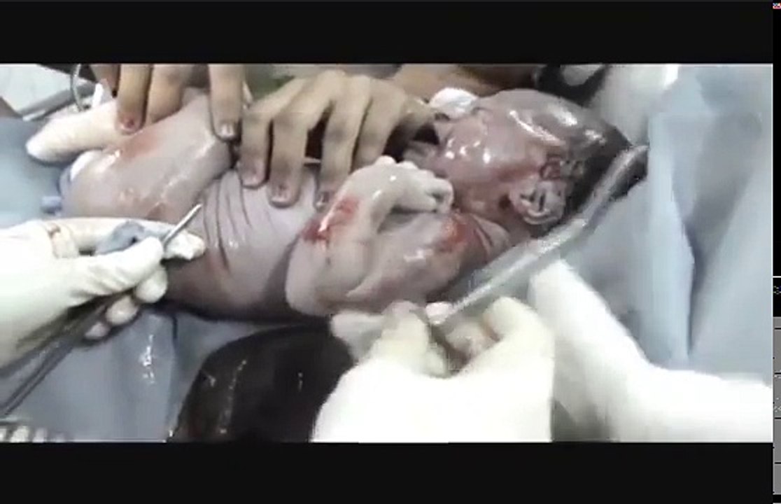 Normal Vaginal Delivery with Episiotomy