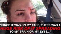 Woman's Terrifying Story Will Have You Thinking Twice Before You Pop a Pimple