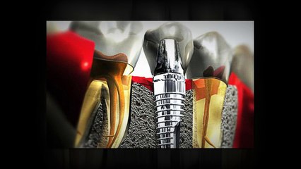 Teeth-in-a-Day Treatment for Full Mouth Rehabilitation