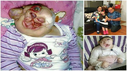 Girl born without a FACE defies the odds to reach her ninth birthday in