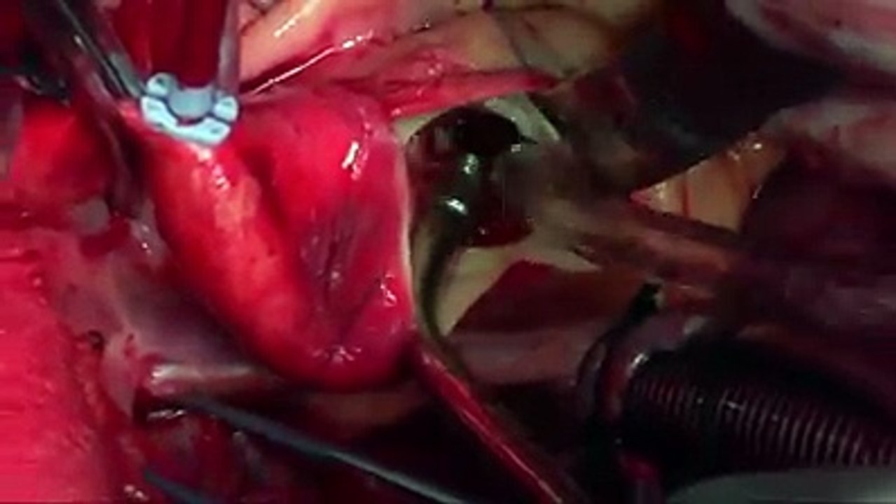 Aortic Heart Valve Replacement Surgery- Medical Videos