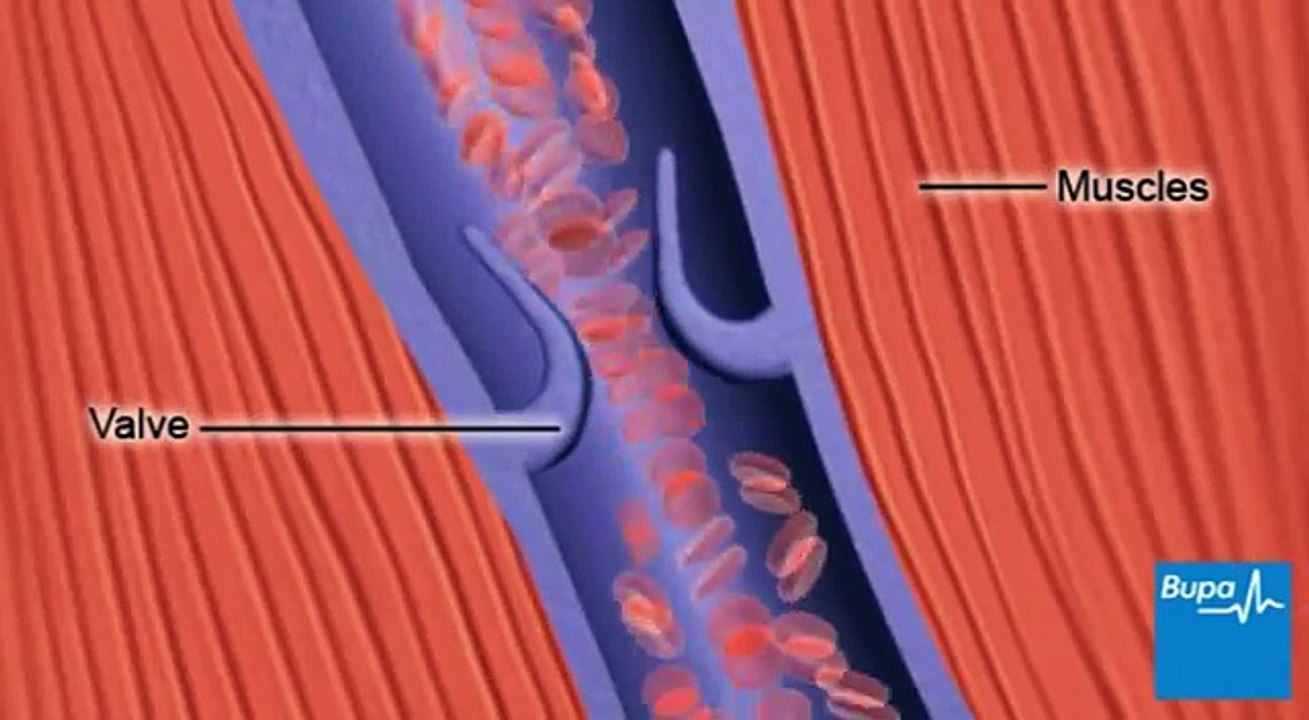 How deep vein thrombosis (DVT) forms- Medical Videos