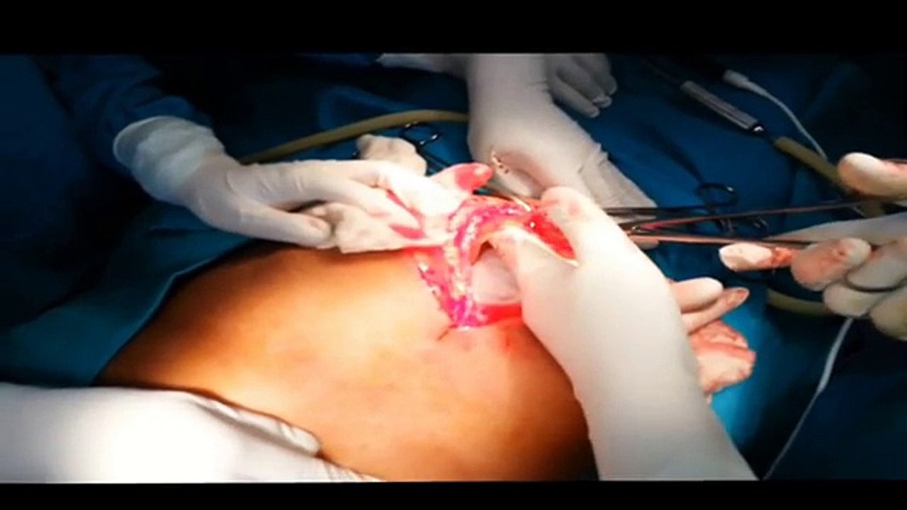 Huge Ovarian Cyst in 85 years Old Woman Removal Surgery- Medical Videos