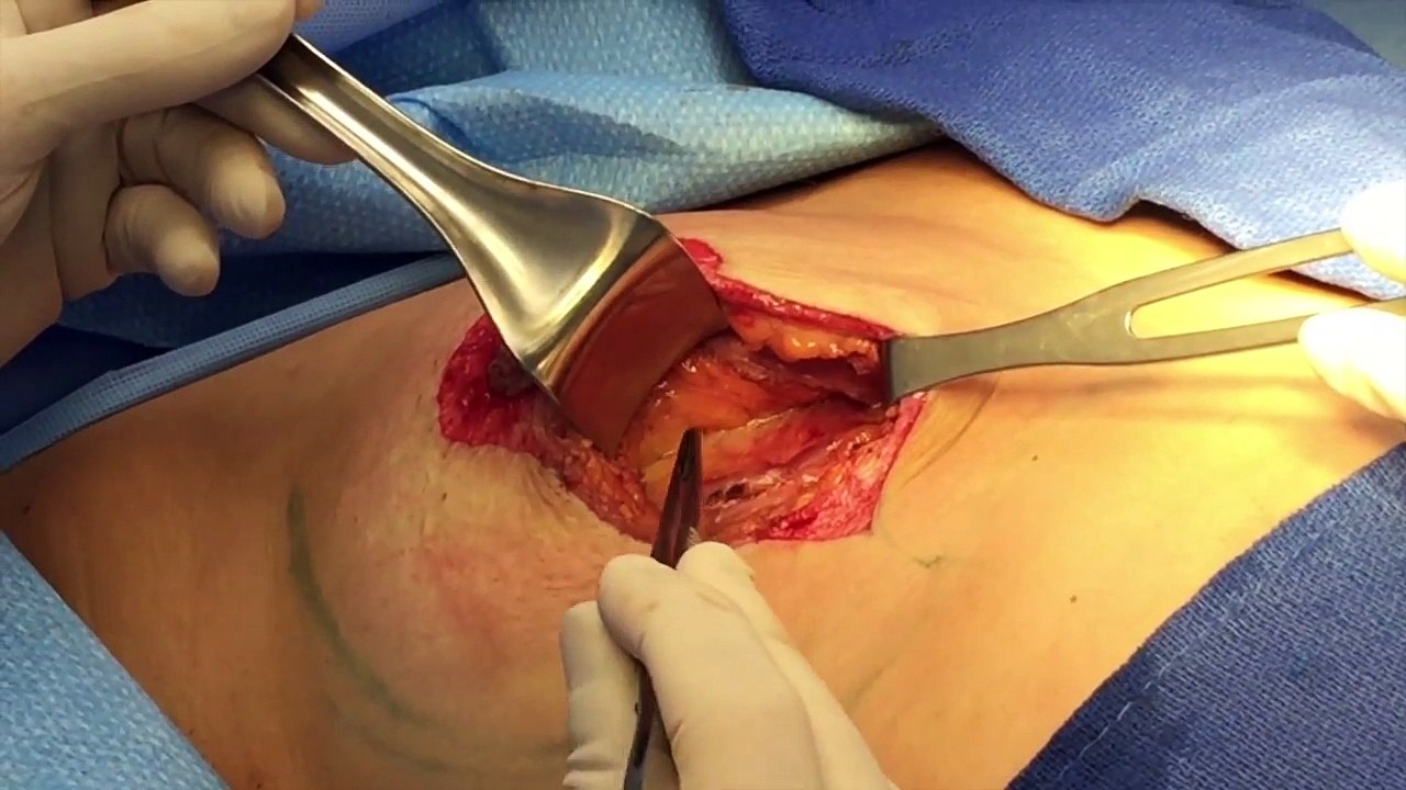 Intrafascial Female Breast Dissection Surgery- Medical Videos