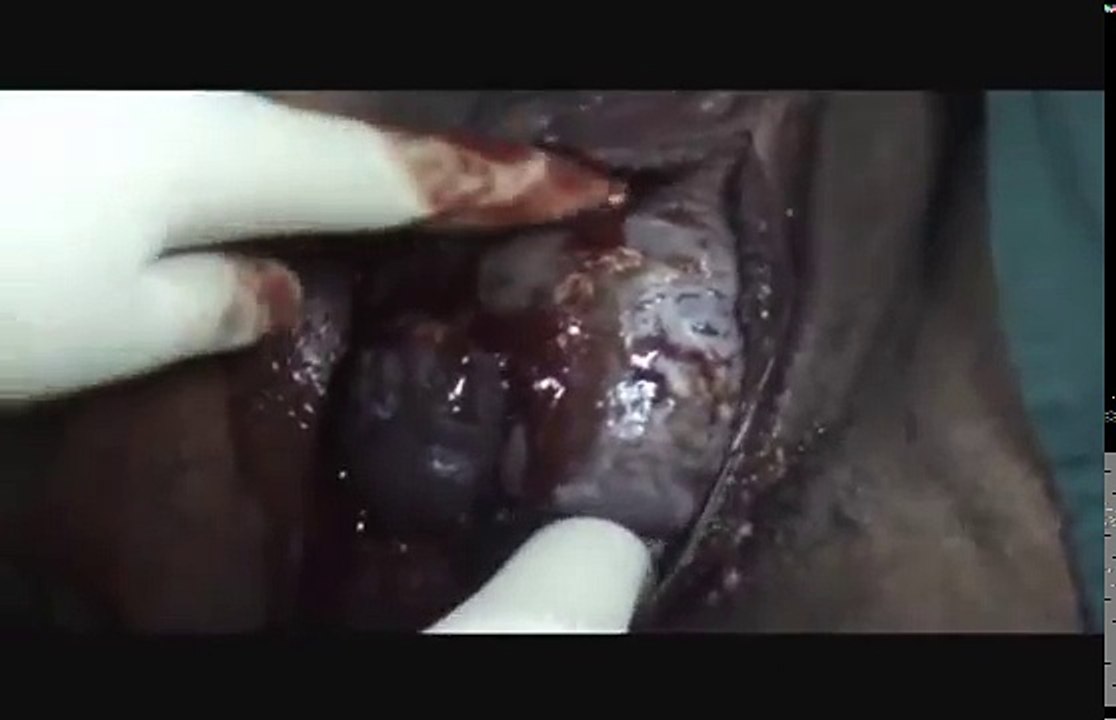 Assisted Breech Delivery