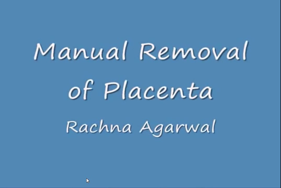Manual Separation of the Placenta