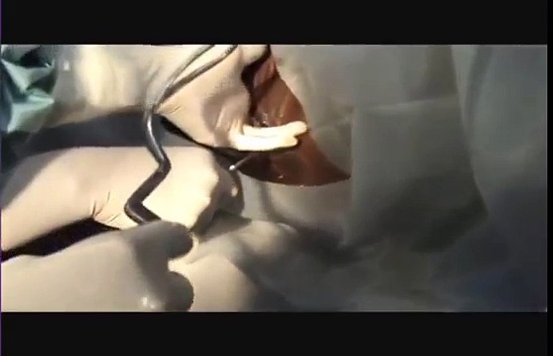 Outlet Forceps Delivery with Cervical Exploration