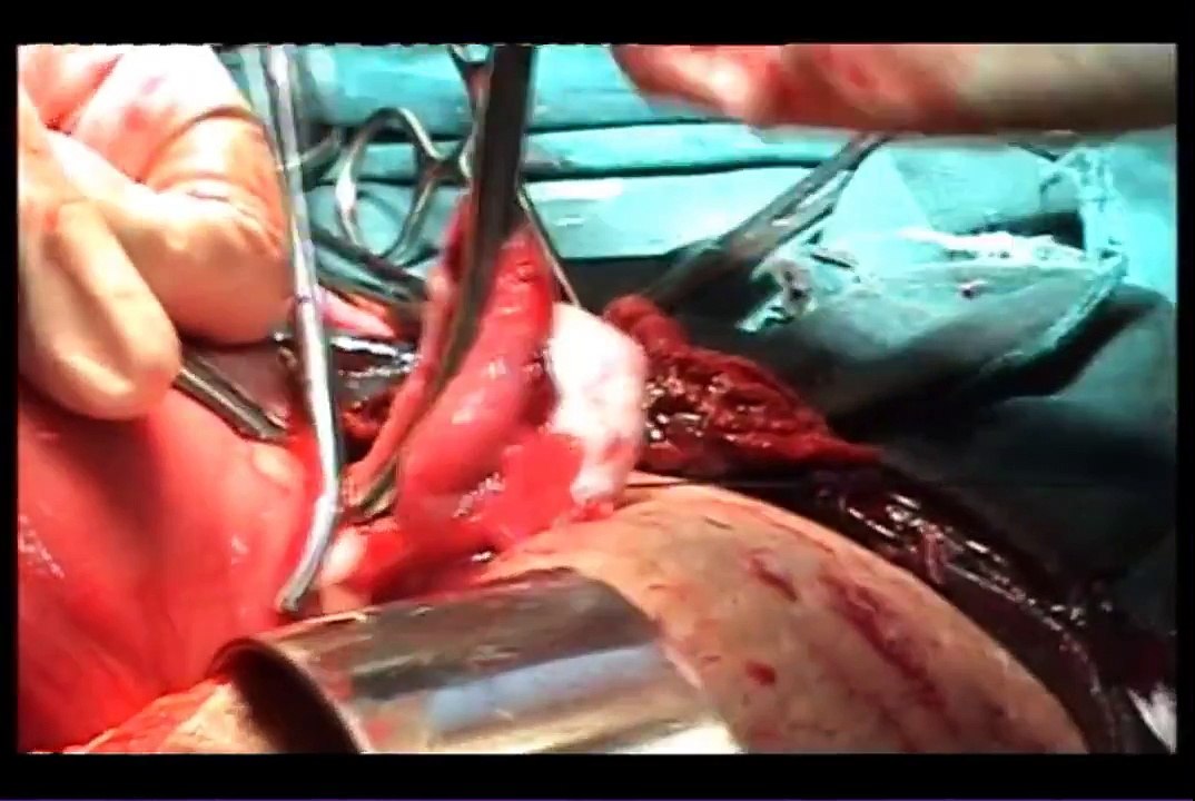 Classical CS with Cesarean Hysterectomy for Placenta Percreta