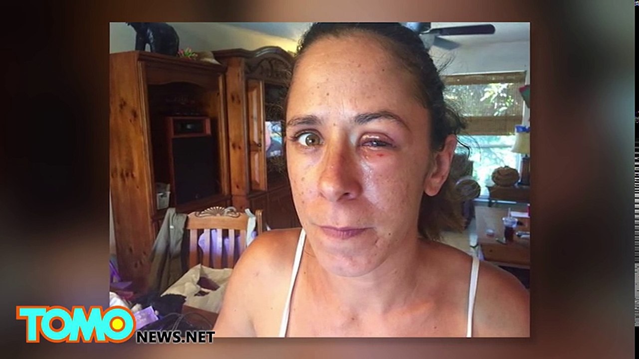 Woman accidentally glues eyes shut with superglue