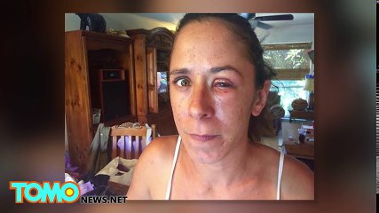 Woman accidentally glues eyes shut with superglue