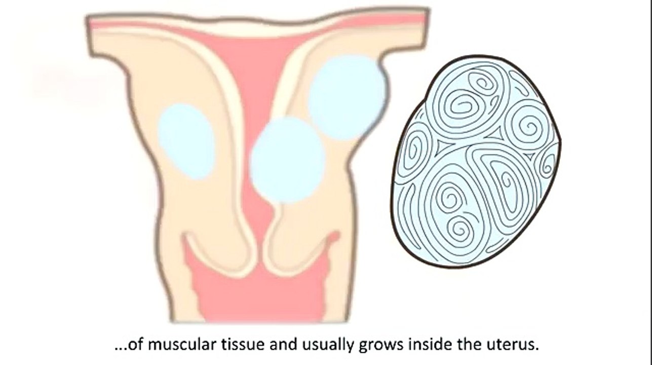 What are Vaginal Fibroids - Causes  Symtops and Removal- Medical Videos