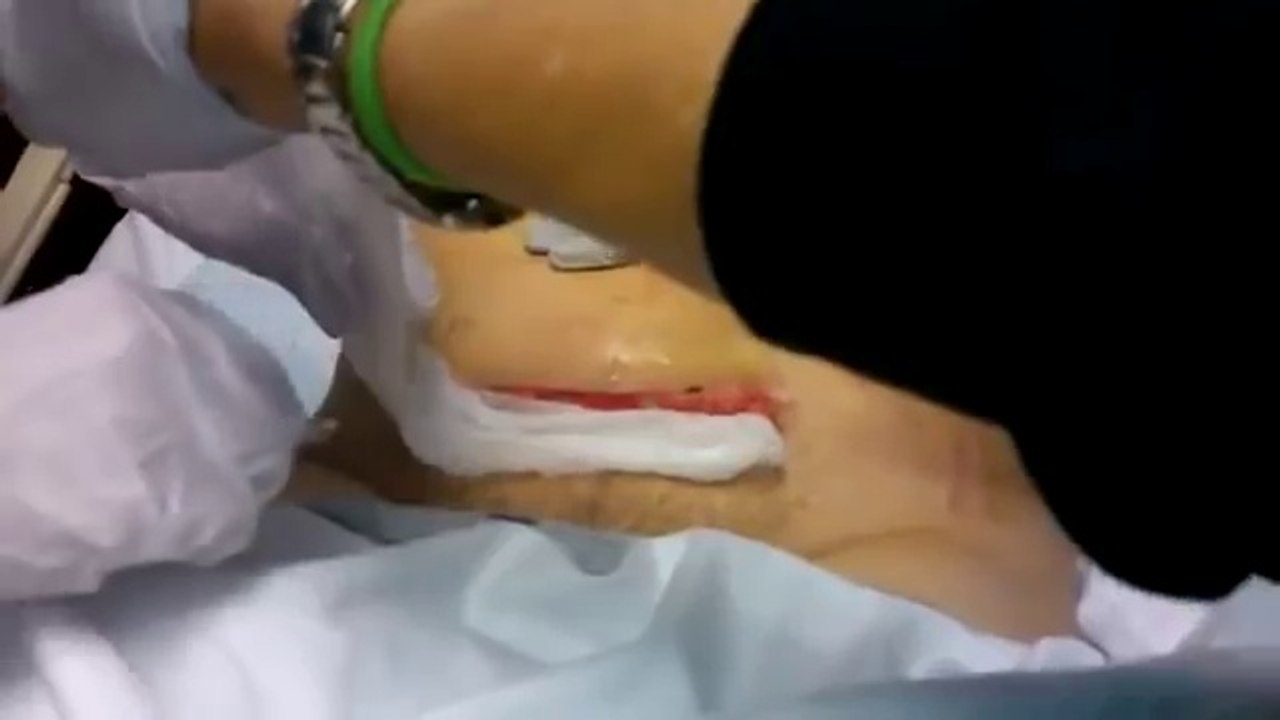 Unhealed Infected Cesarean Incision- Medical Videos