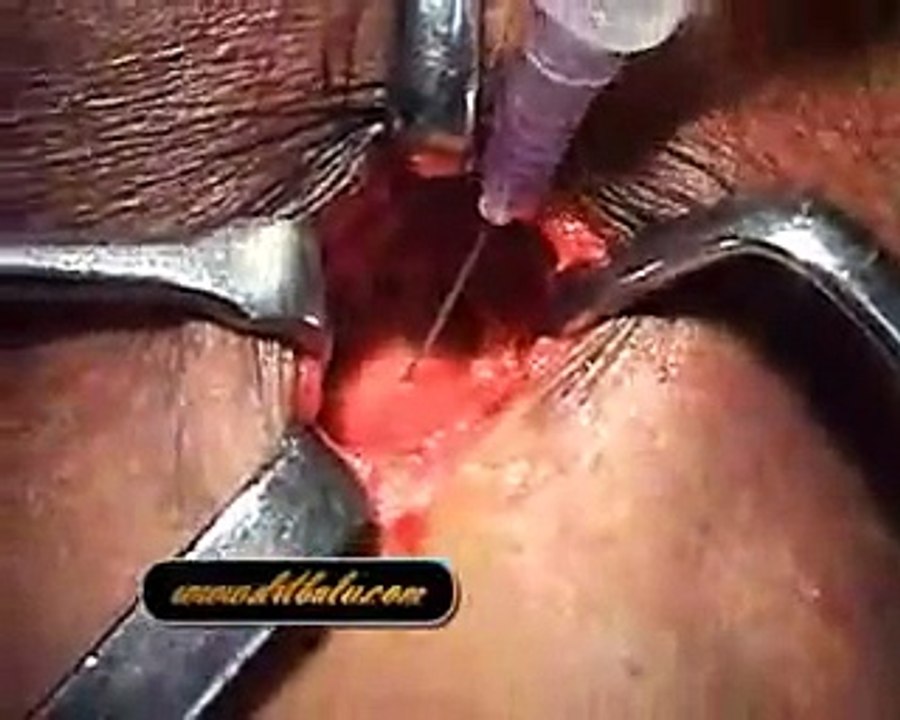 Tracheostomy Emergency Procedure- Medical Videos
