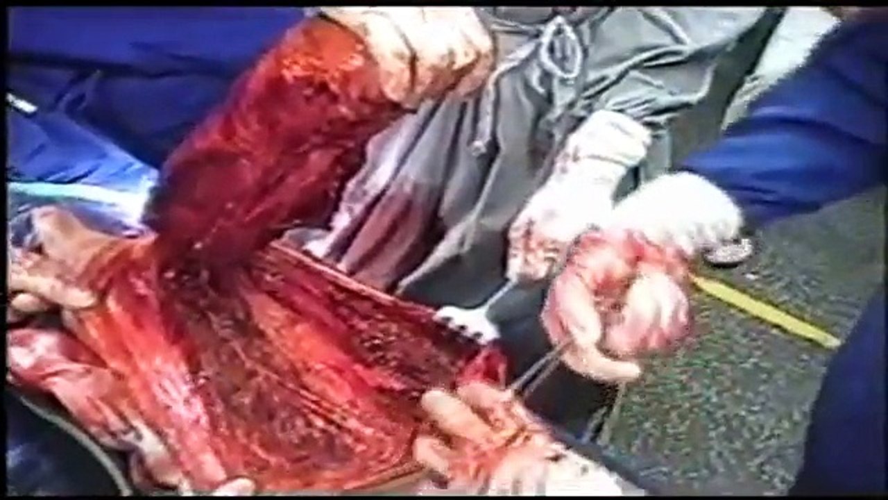 Total Femur Bone Replacement Surgery- Medical Videos