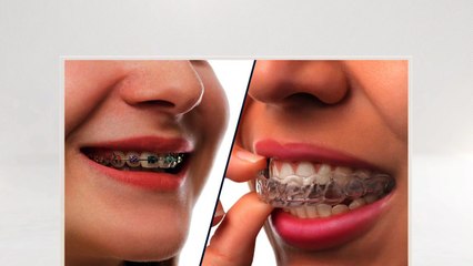 Invisible Dental Braces Specialist and Treatment in Pinecrest