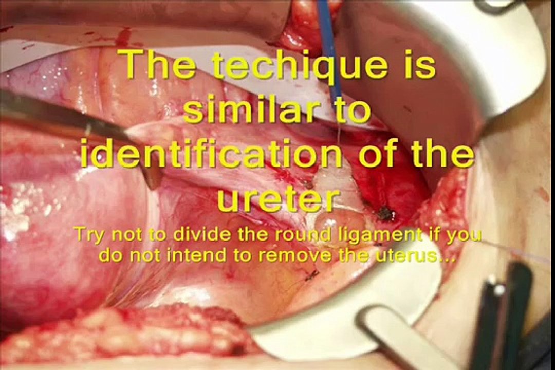 Internal iliac artery ligation VIP