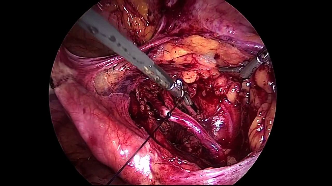 Different techniques of tying the uterine arteries at its origin