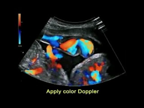 How to do Umbilical Artery Doppler
