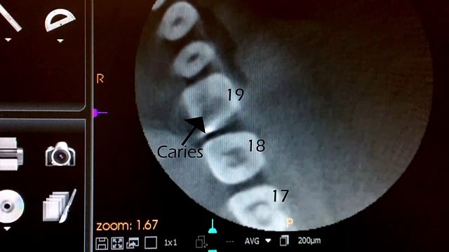 aimms library ct scan course video no 15 Cone-Beam Computed Tomography Image