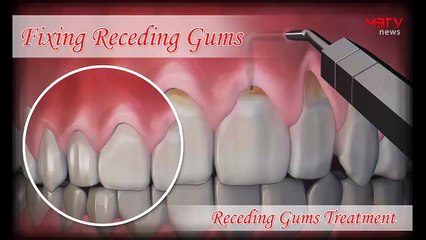 Home Remedies & Treatment of Pyorrhea