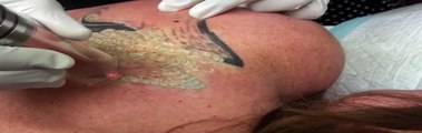 Laser Tattoo Removal Melbourne by Dr Shobhna Singh - Nitai Medical & Cosmetic Centre