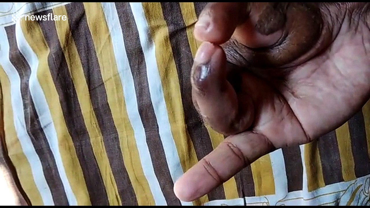 Man gets hand back after surgeons replace thumb with long toe